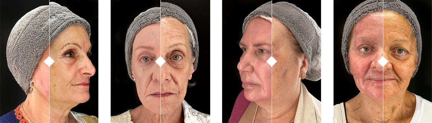 Antes depois